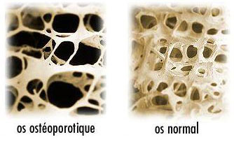 остеопороз при закислении организма